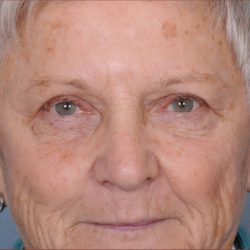 Blepharoplasty Before & After Patient #876