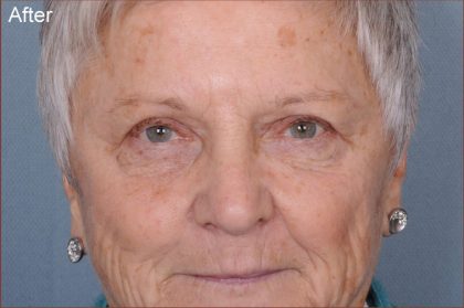 Blepharoplasty Before & After Patient #876