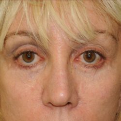 Blepharoplasty Before & After Patient #875