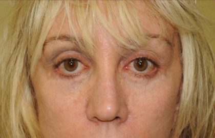 Blepharoplasty Before & After Patient #875