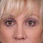 Blepharoplasty Before & After Patient #875