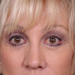 Blepharoplasty Before & After Patient #875