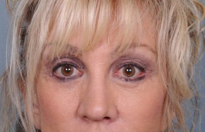 Blepharoplasty Before & After Patient #875