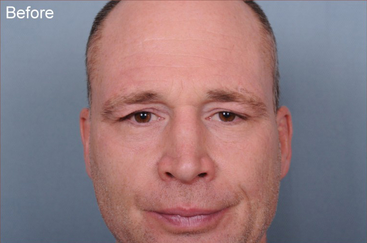 Blepharoplasty Before & After Patient #872