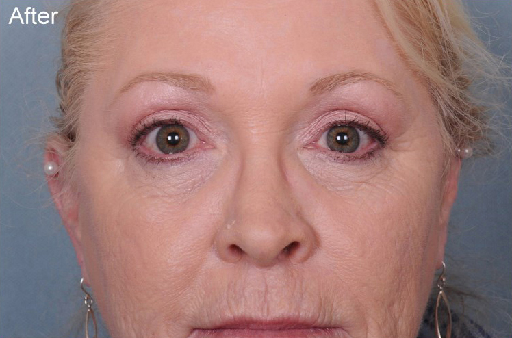 Blepharoplasty Before & After Patient #903