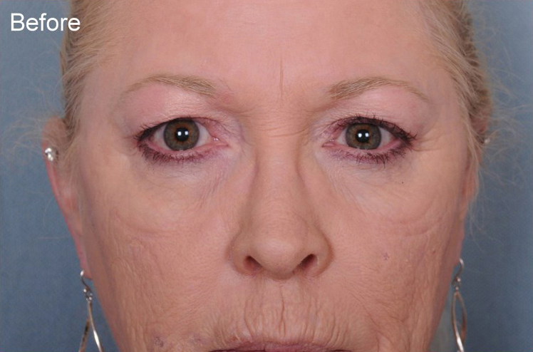 Blepharoplasty Before & After Patient #903
