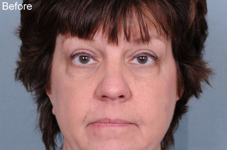 Blepharoplasty Before & After Patient #874