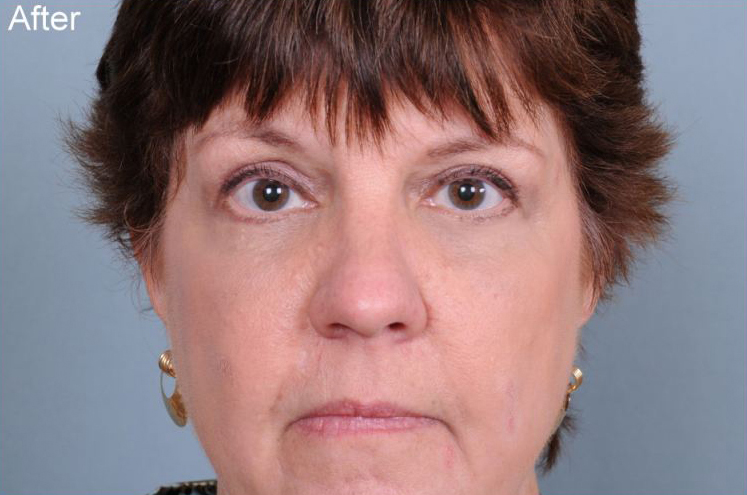 Blepharoplasty Before & After Patient #874