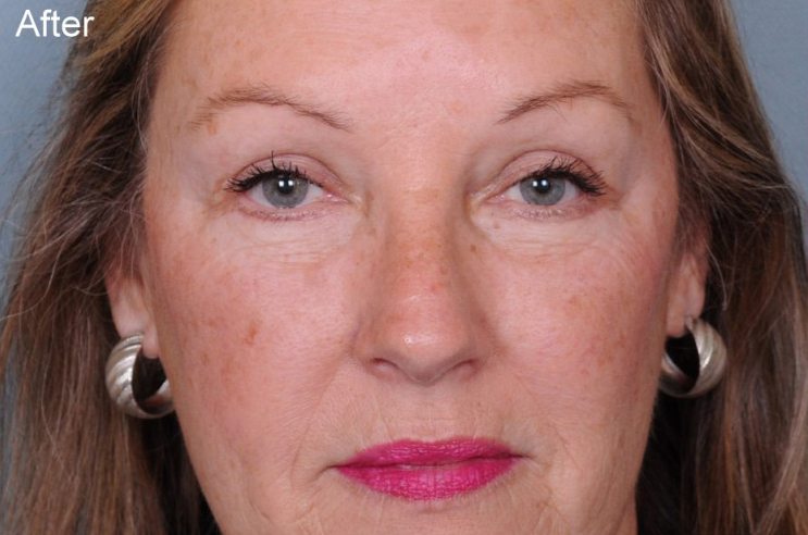 Blepharoplasty Before & After Patient #900