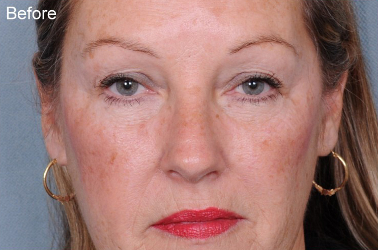 Blepharoplasty Before & After Patient #900
