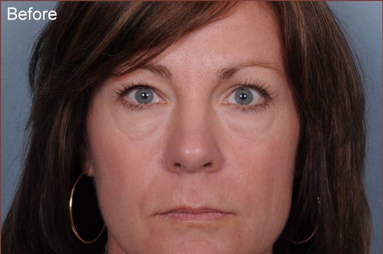 Blepharoplasty Before & After Patient #961