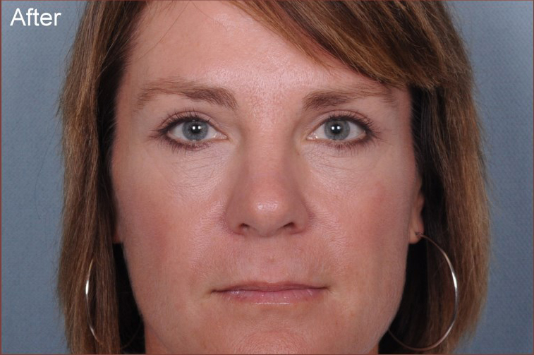 Blepharoplasty Before & After Patient #961