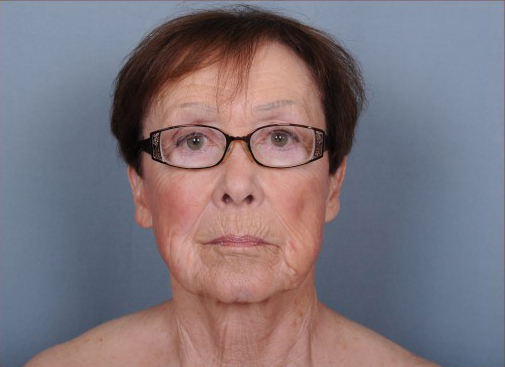 Facelift Before & After Patient #959
