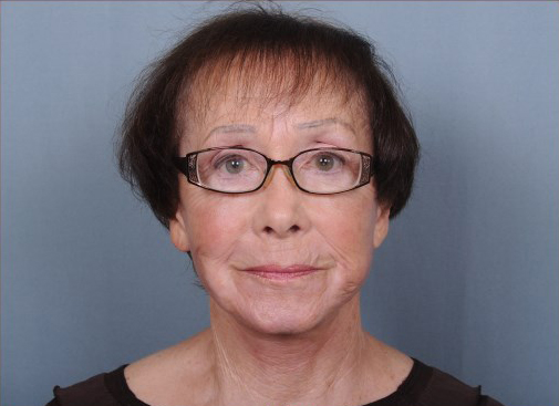 Facelift Before & After Patient #959