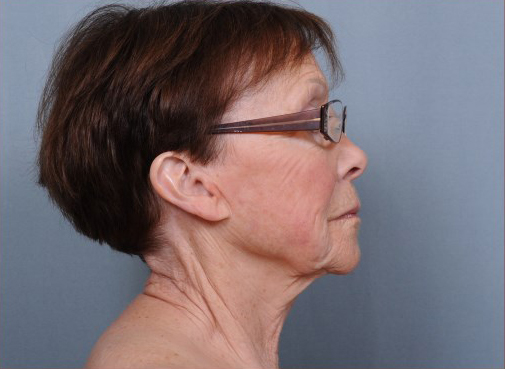 Facelift Before & After Patient #959