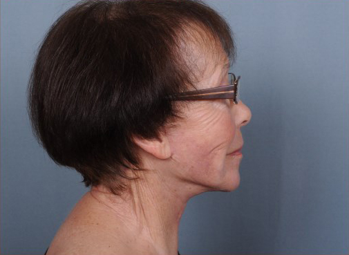 Facelift Before & After Patient #959