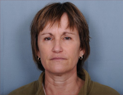 Facelift Before & After Patient #958