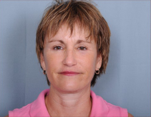 Facelift Before & After Patient #958