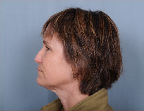 Facelift Before & After Patient #958