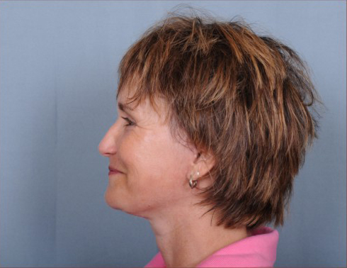 Facelift Before & After Patient #958