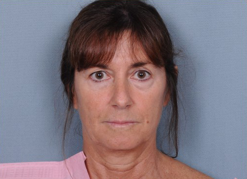 Facelift Before & After Patient #914