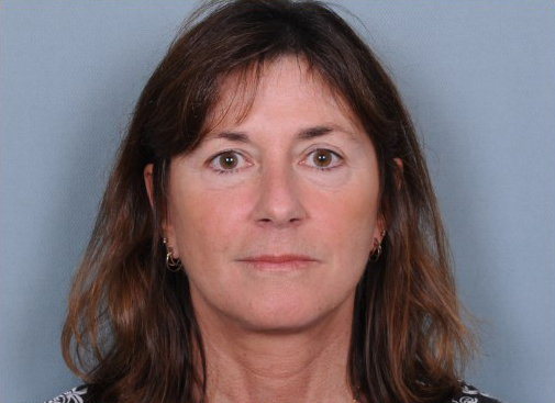 Facelift Before & After Patient #914