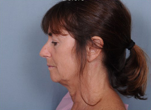 Facelift Before & After Patient #914