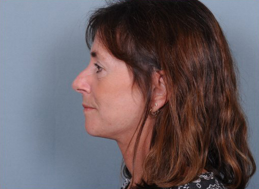 Facelift Before & After Patient #914
