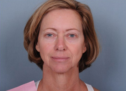 Facelift Before & After Patient #913