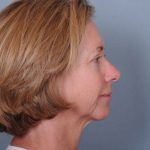 Facelift Before & After Patient #913