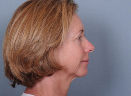 Facelift Before & After Patient #913
