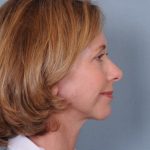 Facelift Before & After Patient #913
