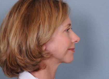Facelift Before & After Patient #913