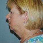 Facelift Before & After Patient #912