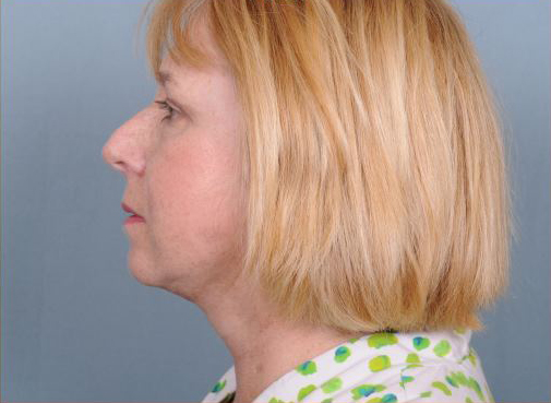 Facelift Before & After Patient #912
