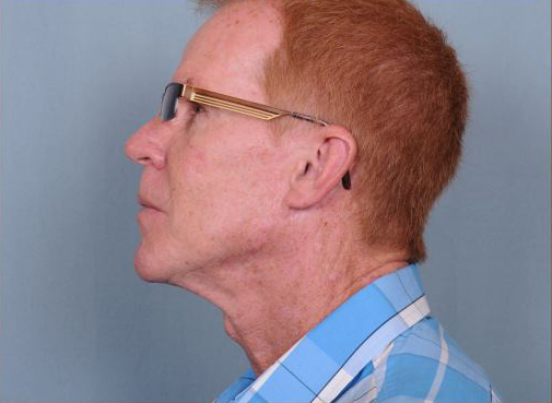 Neck Lift Before & After Patient #910