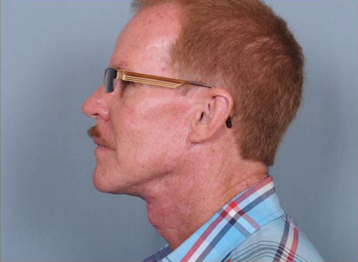 Neck Lift Before & After Patient #910