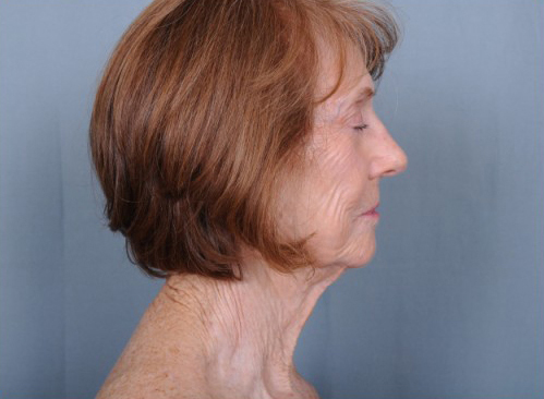 Facelift Before & After Patient #960