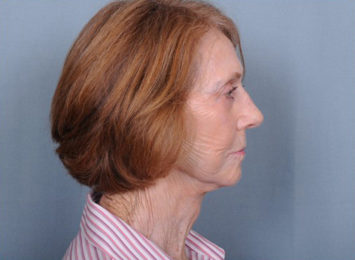 Facelift Before & After Patient #960