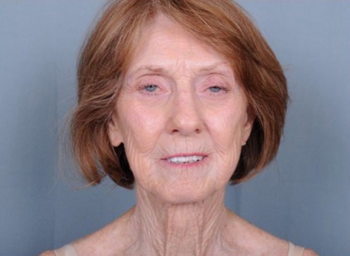 Facelift Before & After Patient #960