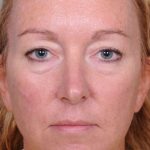 Blepharoplasty Before & After Patient #909