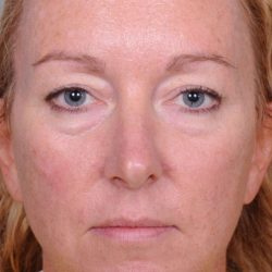 Blepharoplasty Before & After Patient #909