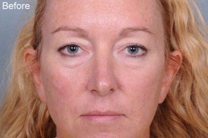 Blepharoplasty Before & After Patient #909