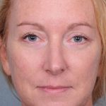 Blepharoplasty Before & After Patient #909