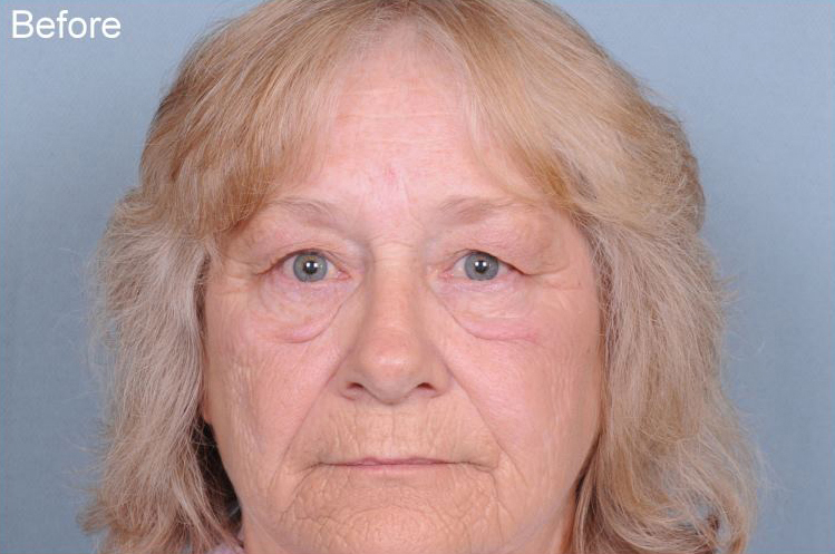 Blepharoplasty Before & After Patient #957