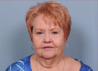 Facelift Before & After Patient #1030