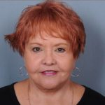 Facelift Before & After Patient #1030