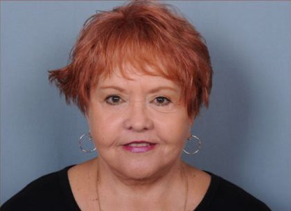 Facelift Before & After Patient #1030