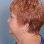 Facelift Before & After Patient #1030