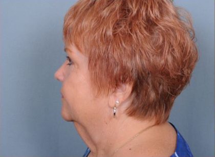 Facelift Before & After Patient #1030